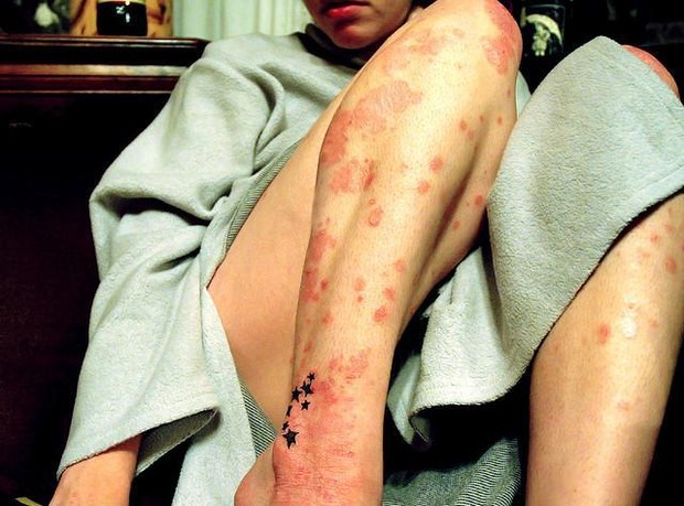 Psoriasis is een belangrijke risicofactor voor depressie